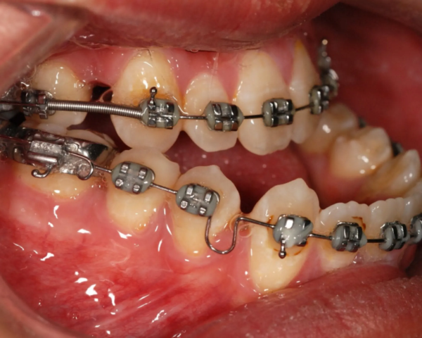 Niềng răng móm là gì? Quy trình, chi phí và hiệu quả chỉnh nha 27 Niềng răng móm có đau không?