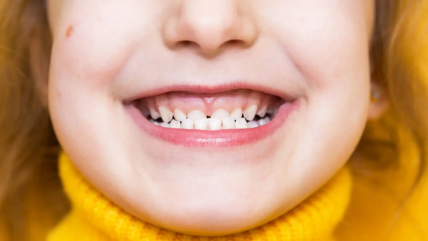 Niềng răng móm là gì? Quy trình, chi phí và hiệu quả chỉnh nha 17 Răng món do bẩm sinh