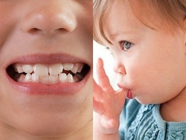 Niềng răng móm là gì? Quy trình, chi phí và hiệu quả chỉnh nha 18 Thói quen sinh hoạt có thể dẫn đến tình trạng răng bị móm