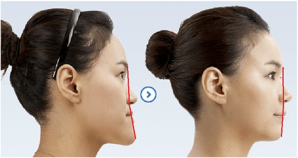 Niềng răng móm là gì? Quy trình, chi phí và hiệu quả chỉnh nha 20 Răng móm gậy mất thẩm mỹ cho khuôn mặt