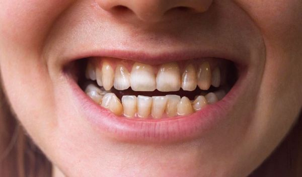 Niềng răng móm là gì? Quy trình, chi phí và hiệu quả chỉnh nha 21 Răng móm thường dễ dẫn đến các bệnh về răng miệng