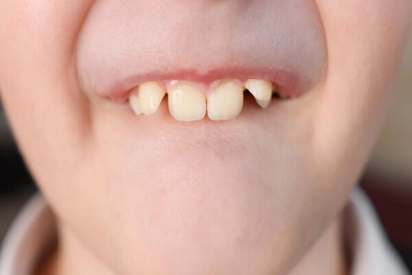 Răng chuột là gì?