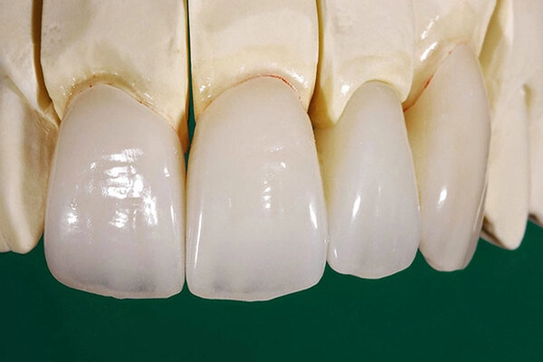 Răng sứ Cercon là gì? Răng sứ Cercon là gì?