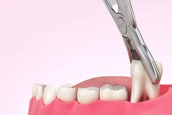 Nhổ răng khôn mọc lệch, mọc ngầm