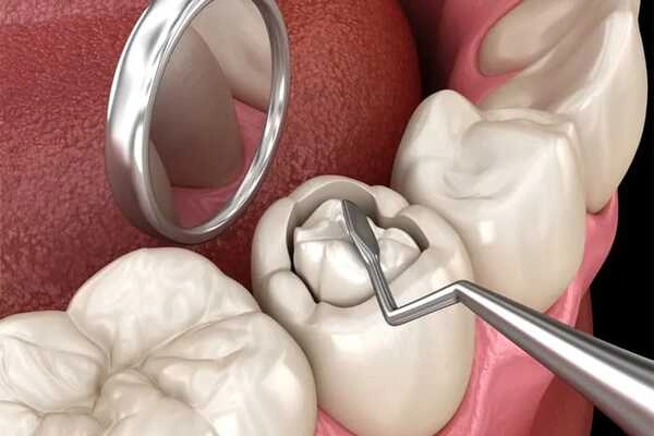 Trám răng là gì?