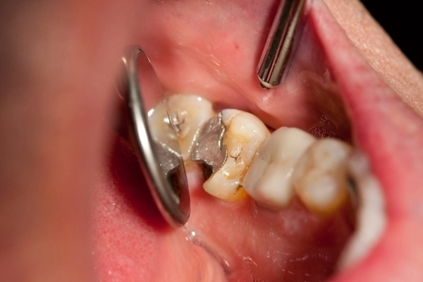 Vết trám bị bong tróc hoặc hở