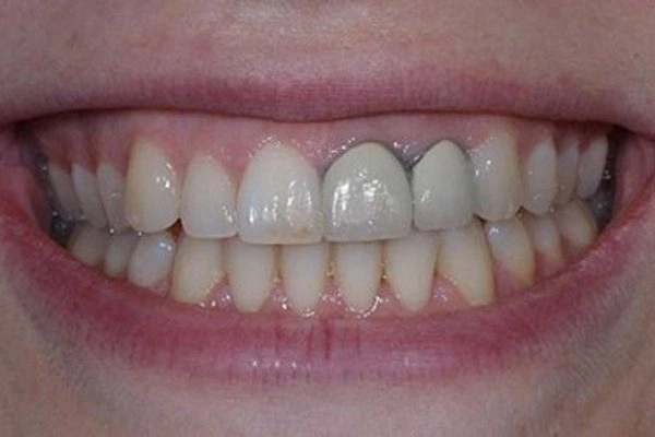 Xuất hiện các vết đen ở răng và nướu