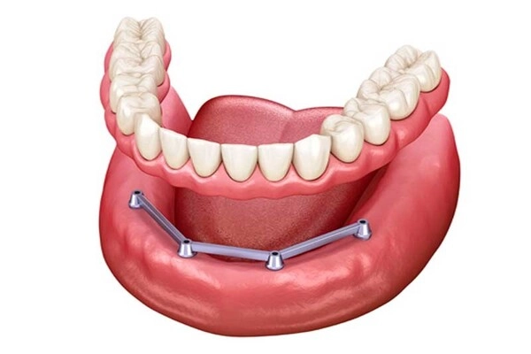 Hàm phủ trên Implant
