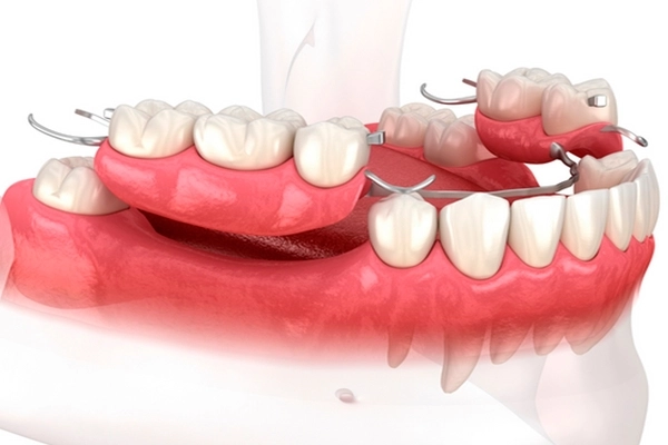 Trồng răng hàm bị sâu giá bao nhiêu?