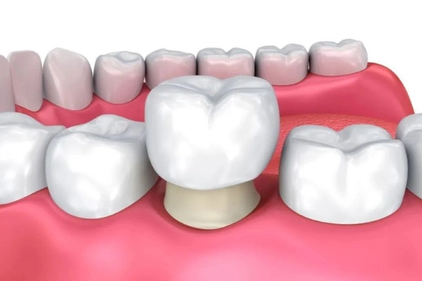 Răng hàm bị sâu có nên bọc sứ không?