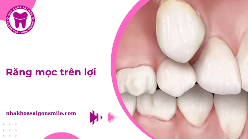 răng mọc trên lợi