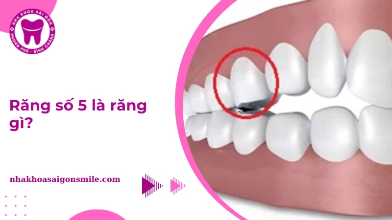 răng số 5