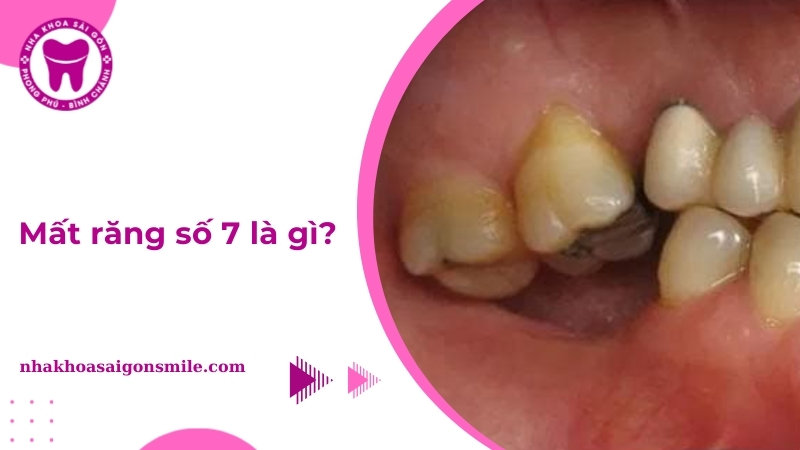 Mất răng số 7 là gì? Nên trồng lại bằng phương pháp nào?