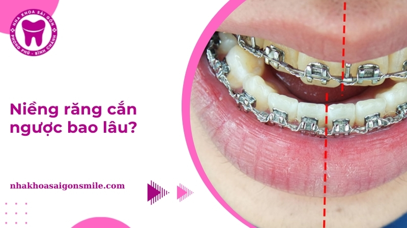 Niềng răng cắn ngược bao lâu? Phương pháp chỉnh khớp cắn ngược