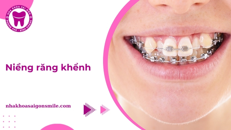 Các phương pháp niềng răng khểnh