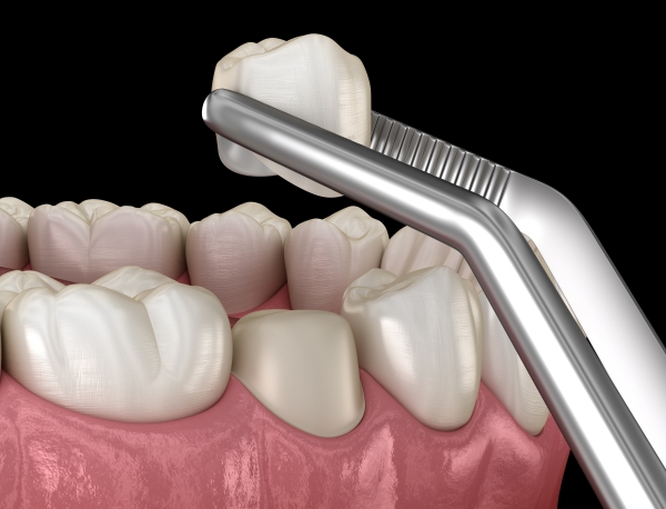 10+ Cách trị ê buốt răng hiệu quả tức thì tại nhà và điều trị dứt điểm 10 Bọc răng sứ là kỹ thuật nha khoa giúp giảm cảm giác ê buốt đáng kể