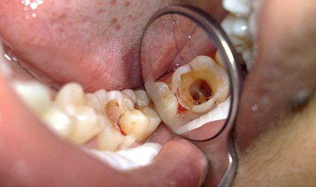 10+ Cách trị ê buốt răng hiệu quả tức thì tại nhà và điều trị dứt điểm 3 Sâu răng chính là nguyên nhân phổ biến nhất gây ê buốt răng