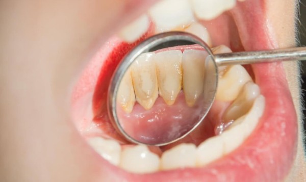 Giai đoạn đầu của cao răng, ít ảnh hưởng nhưng cần cạo vôi sớm để ngăn biến chứng Giai đoạn đầu của cao răng, ít ảnh hưởng nhưng cần cạo vôi sớm để ngăn biến chứng