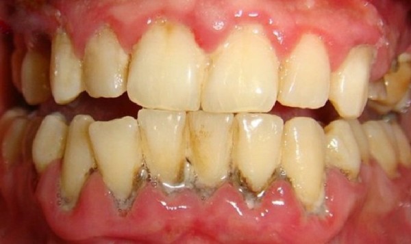 Cao răng đã xâm nhập sâu dưới nướu, cứng, sậm màu, gây viêm nướu, hôi miệng và có nguy cơ mất răng cao Cao răng đã xâm nhập sâu dưới nướu, cứng, sậm màu, gây viêm nướu, hôi miệng và có nguy cơ mất răng cao