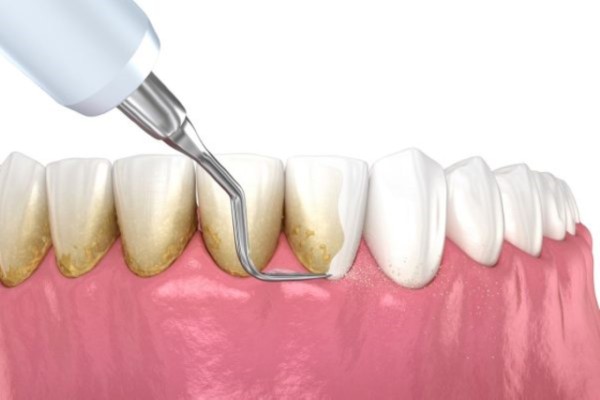 Mỗi cấp độ cần phương pháp làm sạch khác nhau, từ chăm sóc tại nhà đến can thiệp nha khoa chuyên sâu Mỗi cấp độ cần phương pháp làm sạch khác nhau, từ chăm sóc tại nhà đến can thiệp nha khoa chuyên sâu