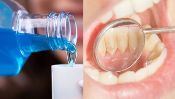 Duy trì vệ sinh răng miệng đúng cách, kết hợp cạo vôi định kỳ để hạn chế mảng bám quay trở lại Duy trì vệ sinh răng miệng đúng cách, kết hợp cạo vôi định kỳ để hạn chế mảng bám quay trở lại