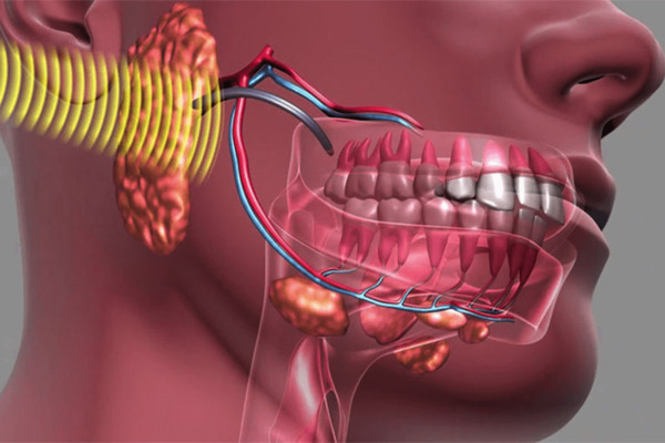 Nguyên nhân gây đau quai hàm Nguyên nhân gây đau quai hàm