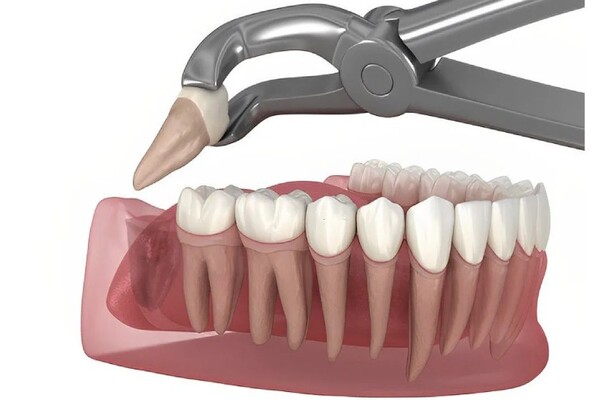 Nhổ răng khôn có thể loại bỏ đau quai hàm Nhổ răng khôn có thể loại bỏ đau quai hàm