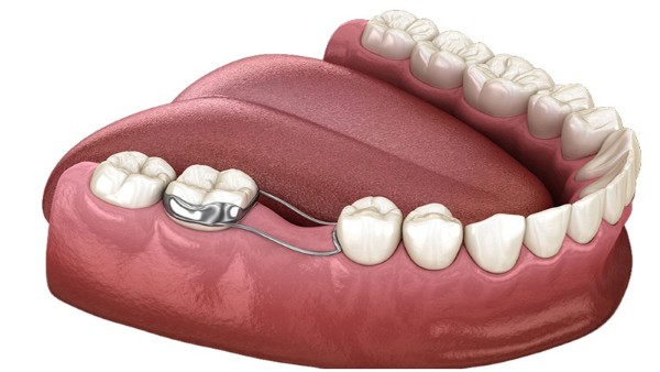 Hàm giữ khoảng được thiết kế riêng, dễ đeo và an toàn cho trẻ nhỏ Hàm giữ khoảng được thiết kế riêng, dễ đeo và an toàn cho trẻ nhỏ