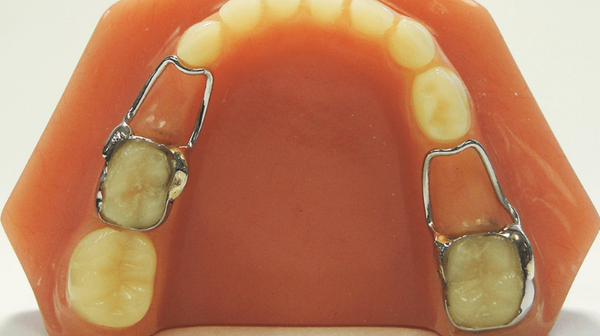 Duy trì khoảng trống sau mất răng sữa, hỗ trợ hàm phát triển cân đối Duy trì khoảng trống sau mất răng sữa, hỗ trợ hàm phát triển cân đối