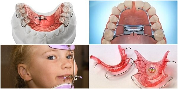 Trẻ thường cần đeo từ vài tháng đến 1–2 năm để răng vĩnh viễn mọc đúng vị trí Trẻ thường cần đeo từ vài tháng đến 1–2 năm để răng vĩnh viễn mọc đúng vị trí