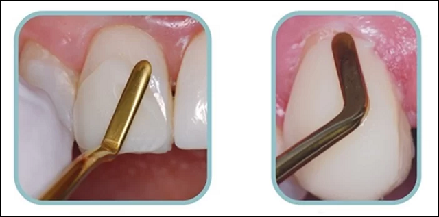 Hở chân răng là gì? Nguyên nhân và cách điều trị giúp bạn tự tin 6 Trám phủ cổ răng khi bị mòn chân răng