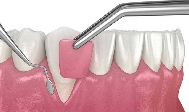 Hở chân răng là gì? Nguyên nhân và cách điều trị giúp bạn tự tin 1 Hở chân răng