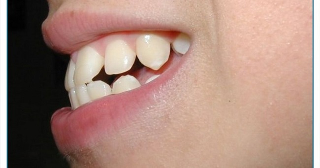 Hô xương ổ răng là gì? Nguyên nhân và cách điều trị hiệu quả 3 Dấu hiệu nhận biết hô xương ổ răng