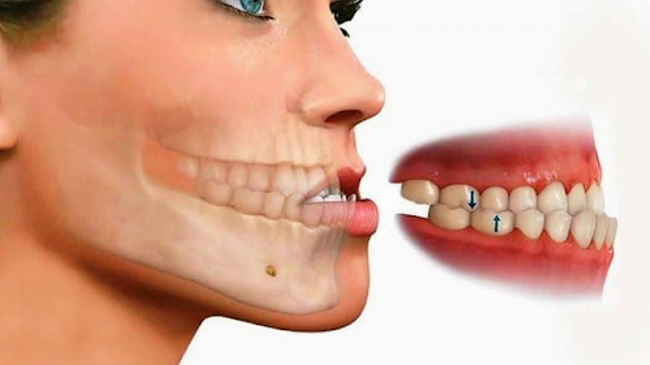 Hô xương ổ răng là gì? Nguyên nhân và cách điều trị hiệu quả 4 Răng cửa hàm trên hoặc hàm dưới nhô quá nhiều