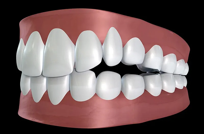 Hô xương ổ răng là gì? Nguyên nhân và cách điều trị hiệu quả 7 Hô xương ổ răng khiến các khe răng, các điểm tiếp xúc không đều