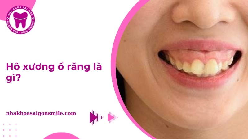 ho xuong o rang thumbnail