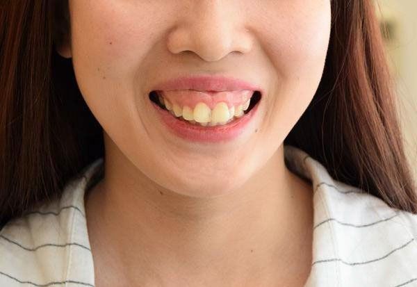 Hô xương ổ răng là gì? Nguyên nhân và cách điều trị hiệu quả 1 Hô xương ổ răng là gì