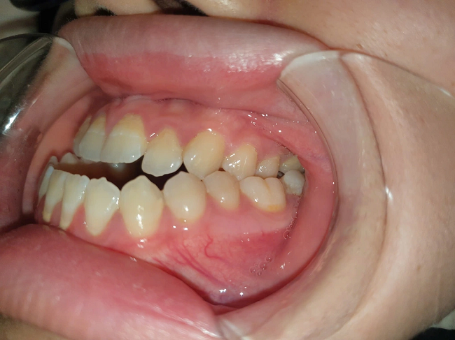 Mặt lưỡi cày là gì? Phương pháp cải thiện mặt lưỡi cày hiệu quả 2 Dấu hiệu nhận biết mặt lưỡi cày