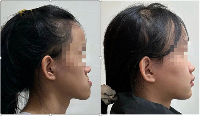 Mặt lưỡi cày là gì? Phương pháp cải thiện mặt lưỡi cày hiệu quả 5 Mặt lưỡi cày có ảnh hưởng gì không?