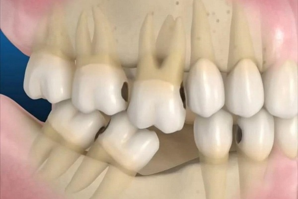 Mức độ ảnh hưởng của việc mất răng số 6 Mức độ ảnh hưởng của việc mất răng số 6