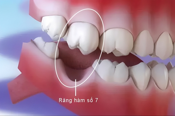 Mất răng số 7 là gì? Mất răng số 7 là gì?