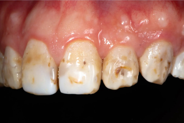 Sâu răng đen gây hỏng men răng Sâu răng đen gây hỏng men răng