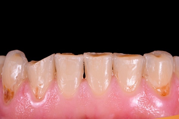 Bề mặt răng mòn, lộ lớp ngà vàng Bề mặt răng mòn, lộ lớp ngà vàng