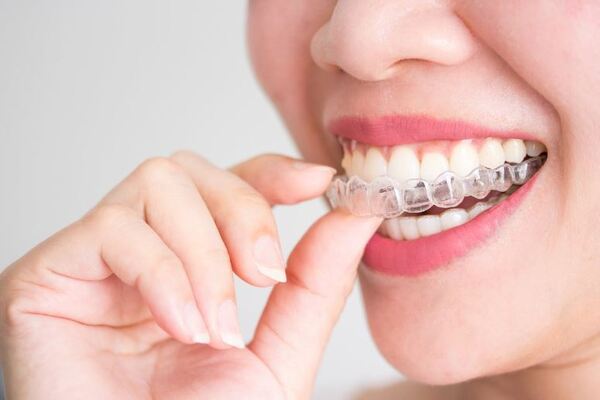 Niềng răng trong suốt Invisalign cho khớp cắn ngược Niềng răng trong suốt Invisalign cho khớp cắn ngược