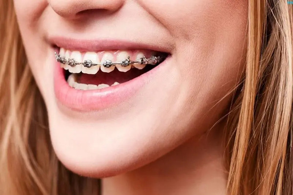 Chi phí niềng răng cắn ngược bao nhiêu? Chi phí niềng răng cắn ngược bao nhiêu?