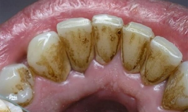 Răng bị đen ở mặt trong là gì? Răng bị đen ở mặt trong là gì?