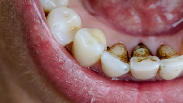 Các dấu hiệu cho thấy răng đang bị đen ở mặt trong Các dấu hiệu cho thấy răng đang bị đen ở mặt trong