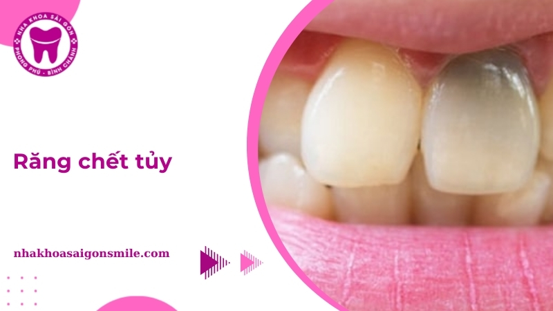 Răng chết tủy