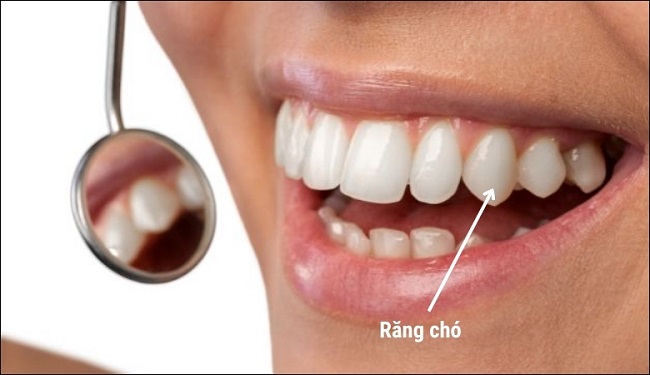 Răng chó là răng gì? Tính cách, vận mệnh và tướng số của người răng chó 2 Đặc điểm nhận biết người có răng chó