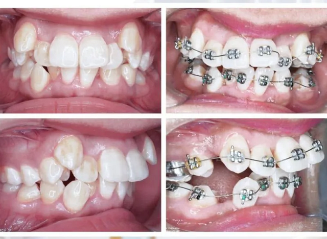 Răng chó là răng gì? Tính cách, vận mệnh và tướng số của người răng chó 6 Niềng răng là phương pháp phổ biến nhất trong chỉnh hình răng lệch lạc